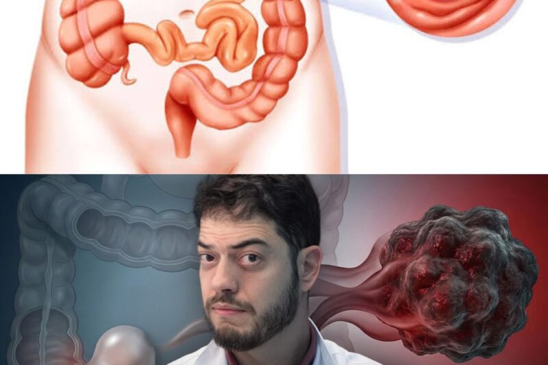 Você sabia que o segundo tipo de câncer mais comum pode ser evitado com uma simples atitude? Muitos ignoram os sinais silenciosos do corpo até ser tarde demais. O câncer colorretal não escolhe idade, mas o conhecimento é a sua maior arma de defesa contra essa doença devastadora. Entender como pólipos benignos se transformam em ameaças letais é o primeiro passo para garantir a sua saúde e o seu futuro. Não deixe o medo ou o desconhecido controlar sua vida. Descubra agora as estratégias essenciais para se proteger clicando no link abaixo.